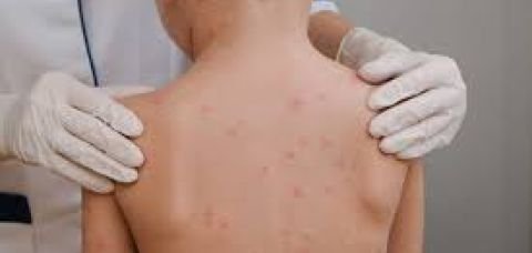 Meningite: sintomas podem ser confundidos com Ebola?